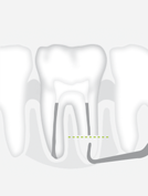 W&H R3D — Тонкая насадка с алмазным покрытием для ретроградной обработки корневого канала