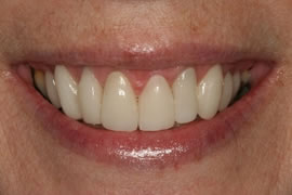 CEREC AC OMNICAM ПРОСТОЕ СКАНИРОВАНИЕ БЕЗ АНТИБЛИКОВОГО СПРЕЯ 25.jpg