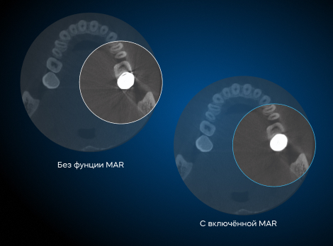 RAY Quantum 10×10 с цефалостатом с функцией уменьшения артефактов от метала MAR Frame 6.jpg