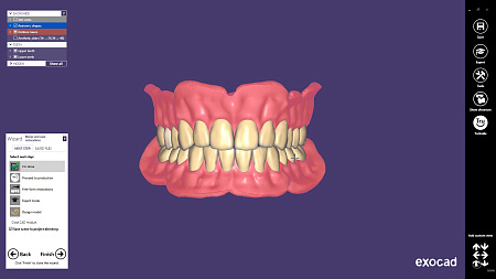 Exocad Full Denture Module - модуль полносъемных протезов
