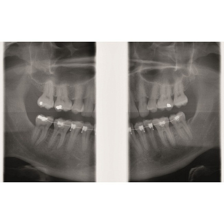 KaVo GENDEX GXDP-300 - цифровая панорамная рентгенодиагностическая система